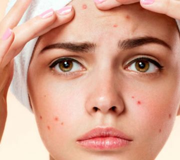 درمان آکنه