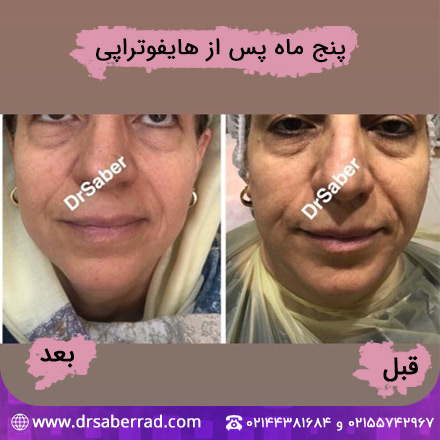 نمونه هایفوتراپی