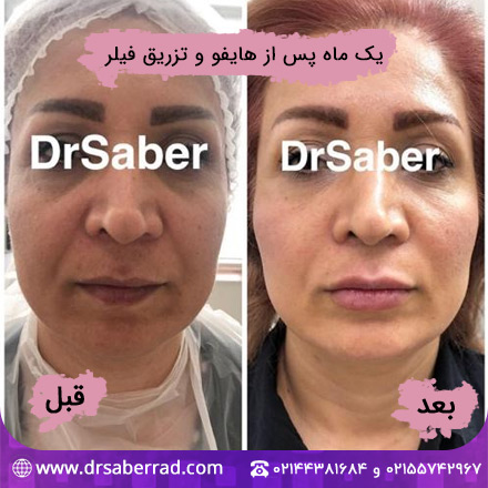 نمونه هایفوتراپی