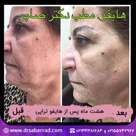 نمونه کار هایفوتراپی
