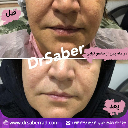 نمونه کار هایفوتراپی