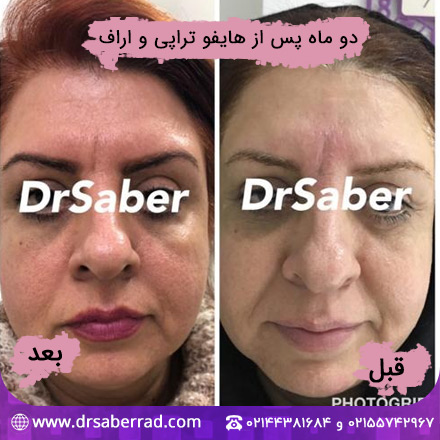 نمونه کار هایفوتراپی