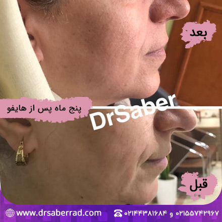 نمونه کار هایفوتراپی