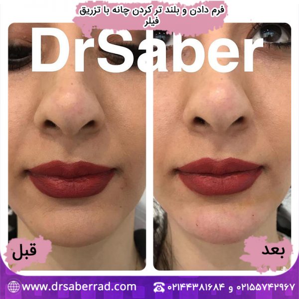 فرم دادن و بلندتر کردن چانه با تزریق فیلر