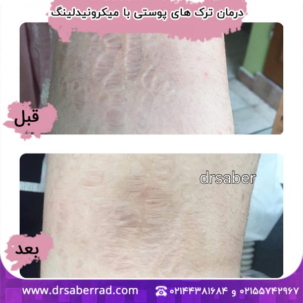 درمان ترک های پوستی با میکرونیدلینگ