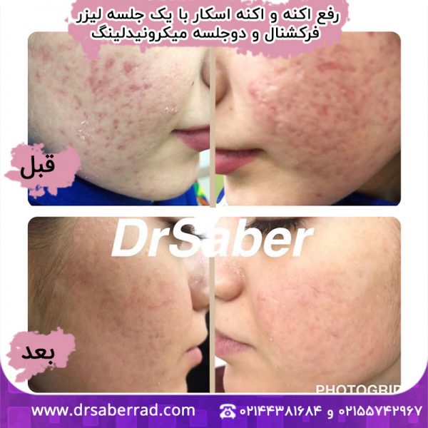 رفع آکنه و آکنه اسکار با یک جلسه لیزر فرکشنال و دو جلسه میکرونیدلینگ