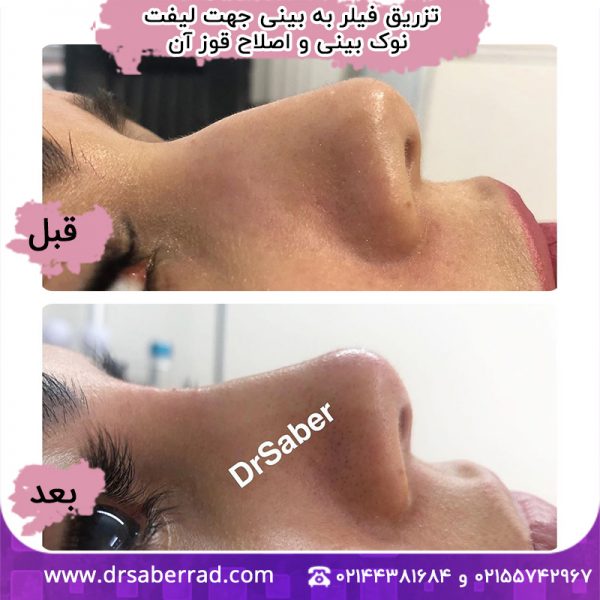 تزریق فیلر به بینی جهت لیفت نوک بینی و اصلاح قوز آن