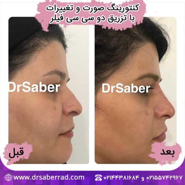 کنتورینگ صورت و تغییرات با تزریق دو سی سی فیلر