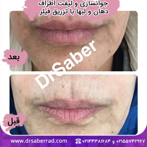 جوانسازی و لیفت اطراف دهان و لبها با تزریق فیلر