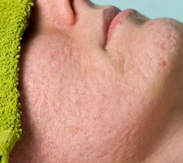 درمان اسکار