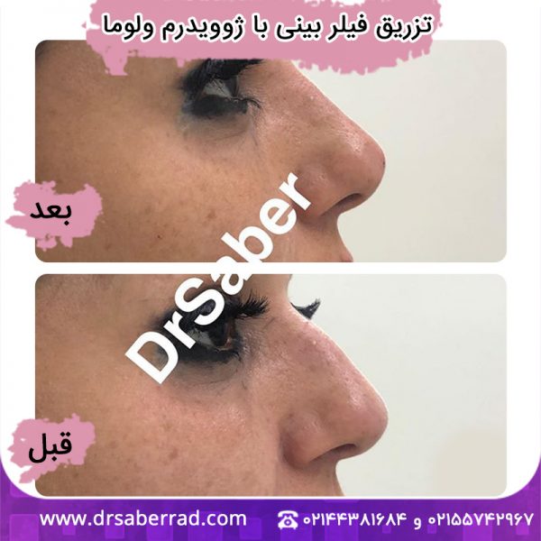تزریق فیلر بینی با ژوویدرم ولوما