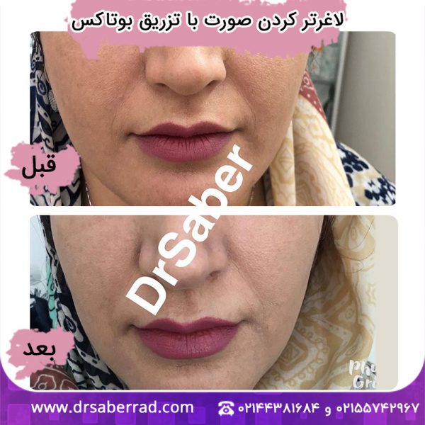 لاغرتر کردن صورت با تزریق بوتاکس