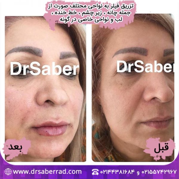 تزریق فیلر به نواحی مختلف صورت