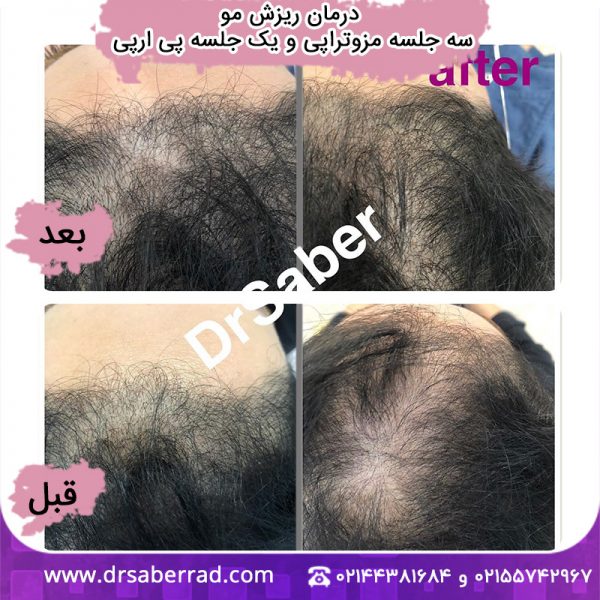 درمان ریزش مو (سه جلسه مزوتراپی و یک جلسه پی ار پی)