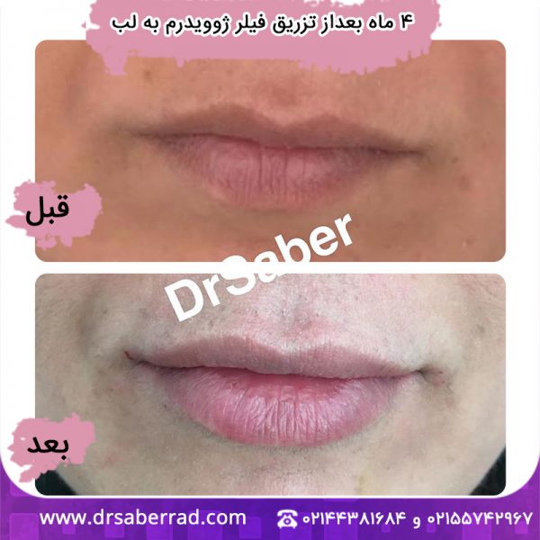 4 ماه بعد از تزریق فیلر ژوویدرم به لب