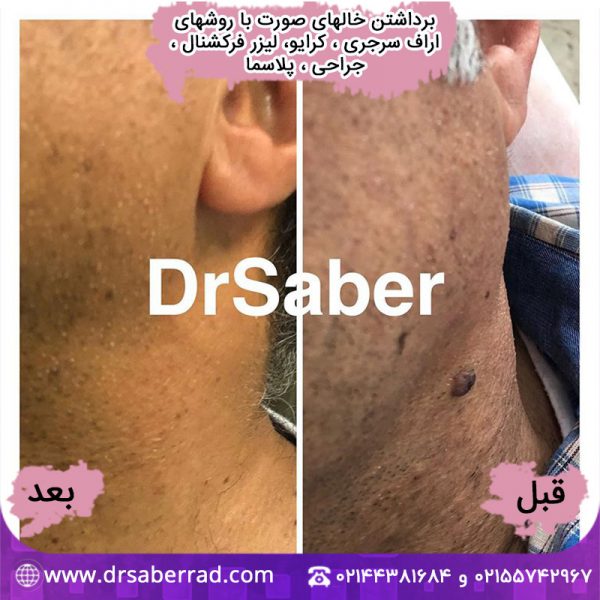برداشتن خال های صورت با روش اراف سرجری، کرایو، لیزر فرکشنال، جراحی و پلاسما