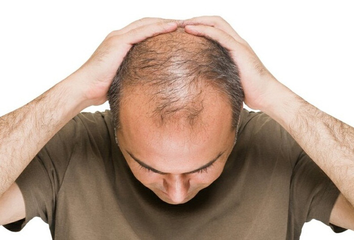 روش های غیر جراحی درمان ریزش مو