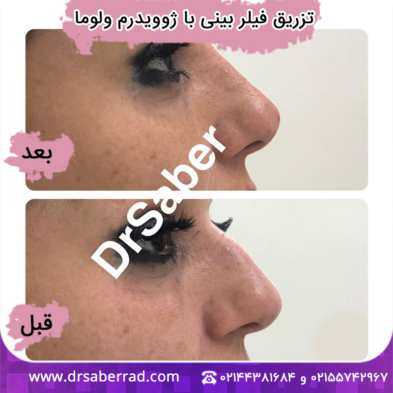 تزریق فیلر بینی
