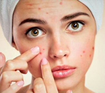 آکنه چیست؟ علل و درمان آکنه