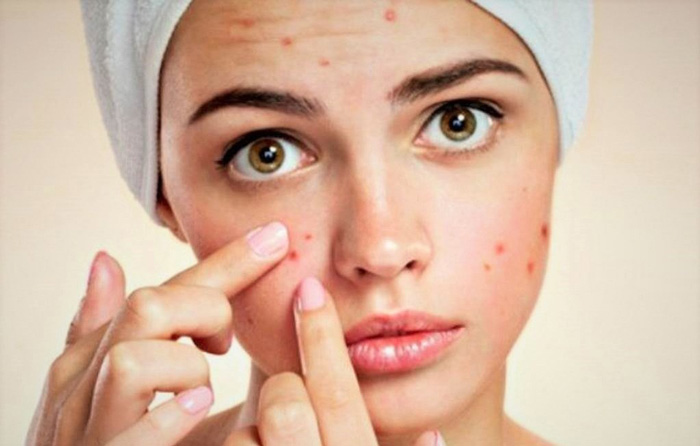 آکنه چیست؟ علل و درمان آکنه