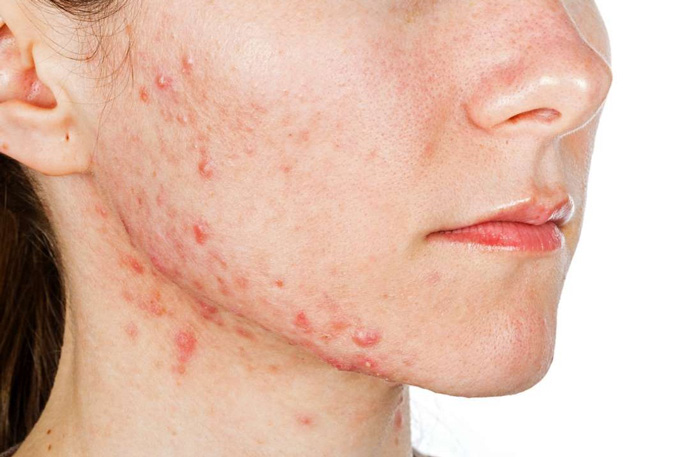 آکنه چیست؟ علل و درمان آکنه