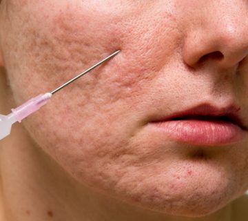 سابسیژن جای آکنه یا اسکار: راهنمایی موثر برای درمان اسکار آکنه