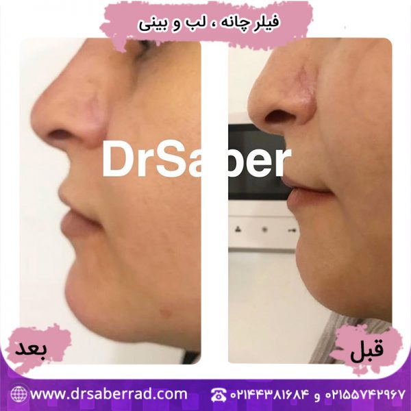 فیلر چانه، لب و بینی