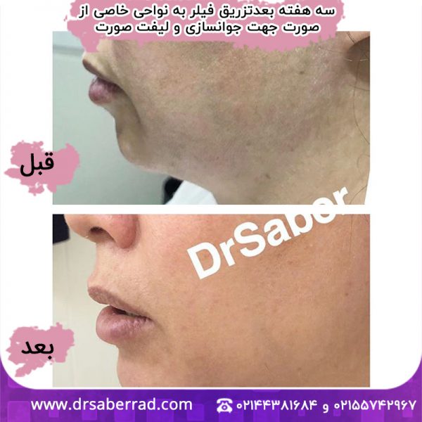 سه هفته بعد از تزریق فیلر به نواحی خاصی از صورت جهت جوانسازی و لیفت صورت