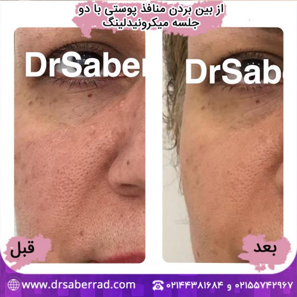 از بین بردن منافذ پوستی با دو جلسه میکرونیدلینگ