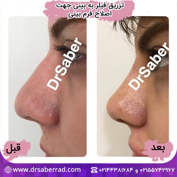 تزریق فیلر به بینی جهت اصلاح فرم بینی