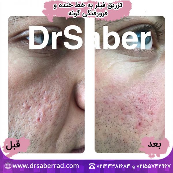 تزریق فیلر به خط خنده و فرو رفتگی گونه