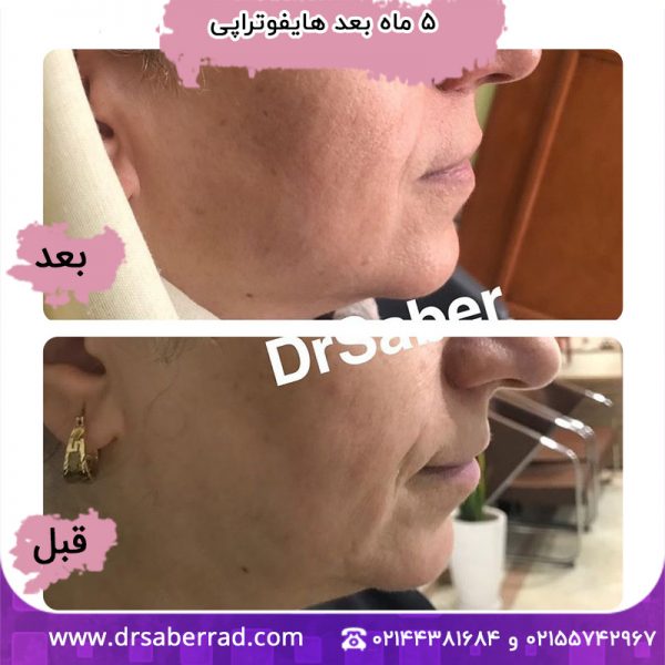 5 ماه بعد از هایفوتراپی