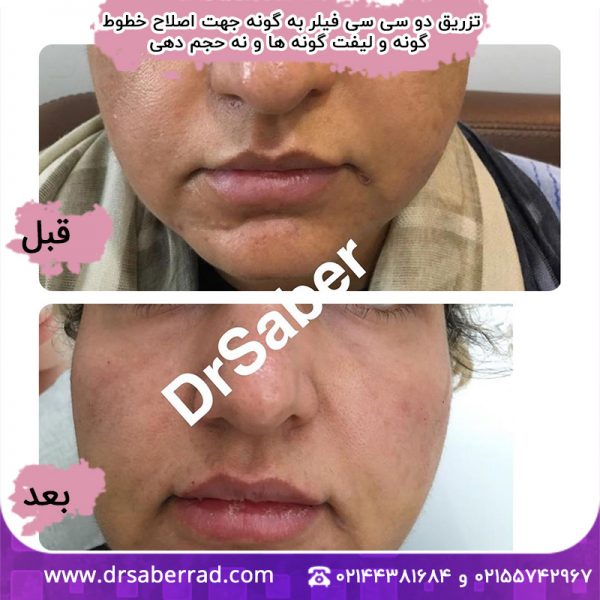 تزریق دو سی سی فیلر به گونه جهت اصلاح خطوط گونه و لیفت