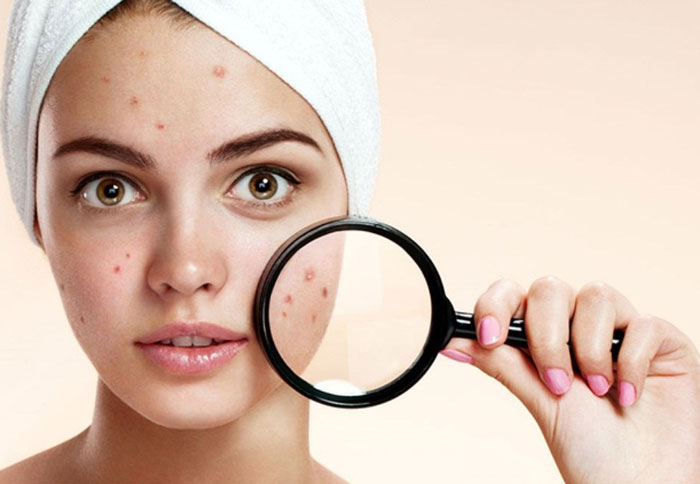 علائم و علت آکنه صورت