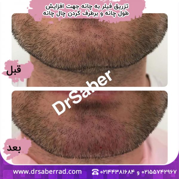 تزریق فیلر به چانه جهت افزایش طول چانه و برطرف کردن چال چانه
