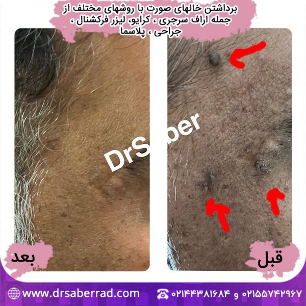 برداشتن خال صورت با روش های مختلف