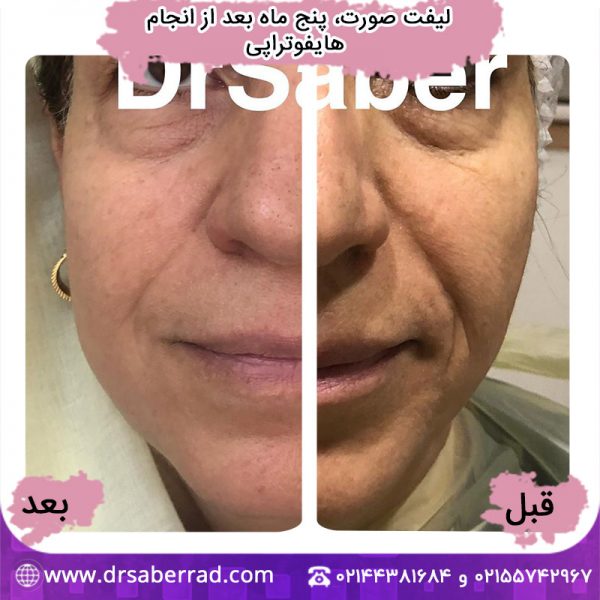 لیفت صورت، 5 ماه بعد از انجام هایفوتراپی