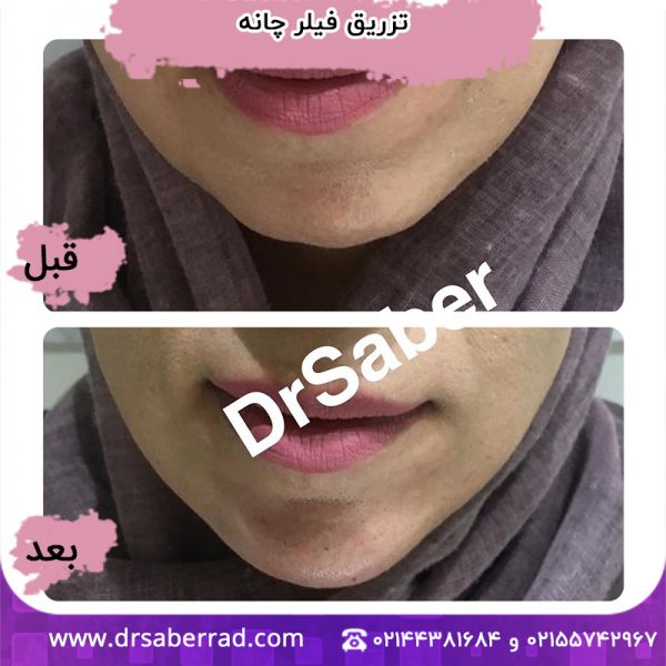 تزریق فیلر چانه