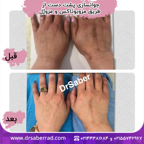 جوانسازی پشت دست از طریق مزوبوتاکس و مزوژل