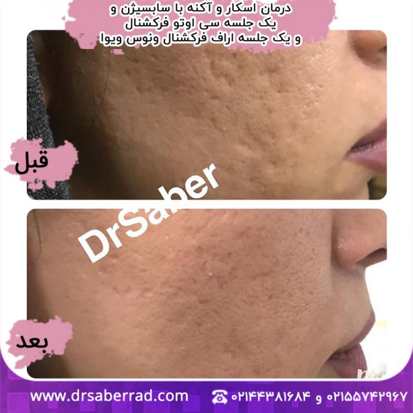 درمان اسکار و آکنه با سابسیژن