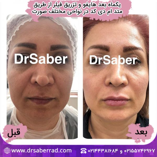 یکماه پس از هایفو و تزریق فیلر