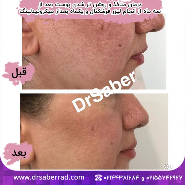 درمان منافذ و روشن تر شدن پوست