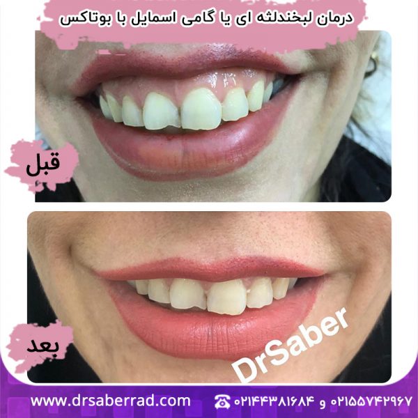 درمان لبخند لثه ای یا گامی اسمایل با بوتاکس