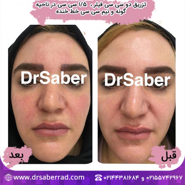 تزریق دو سی سی فیلر برای درمان خط خنده