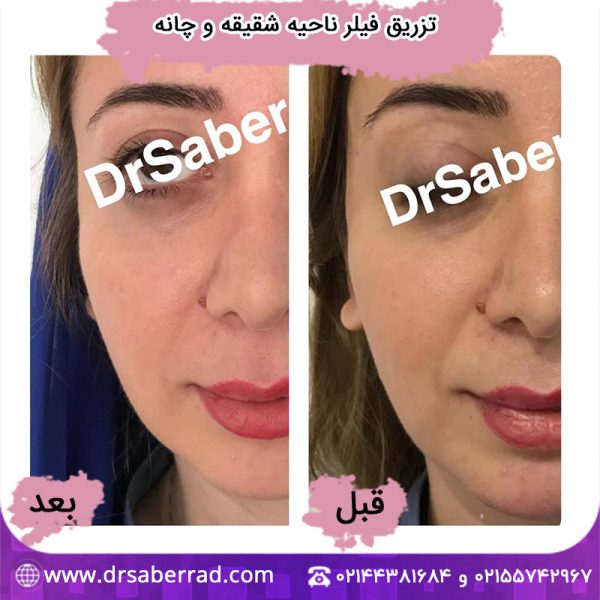 تزریق فیلر ناحیه شقیقه و چانه