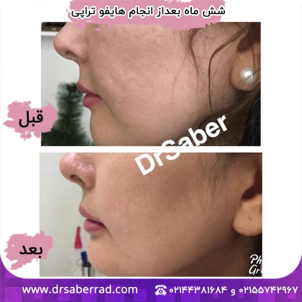 شش ماه بعد از انجام هایفوتراپی