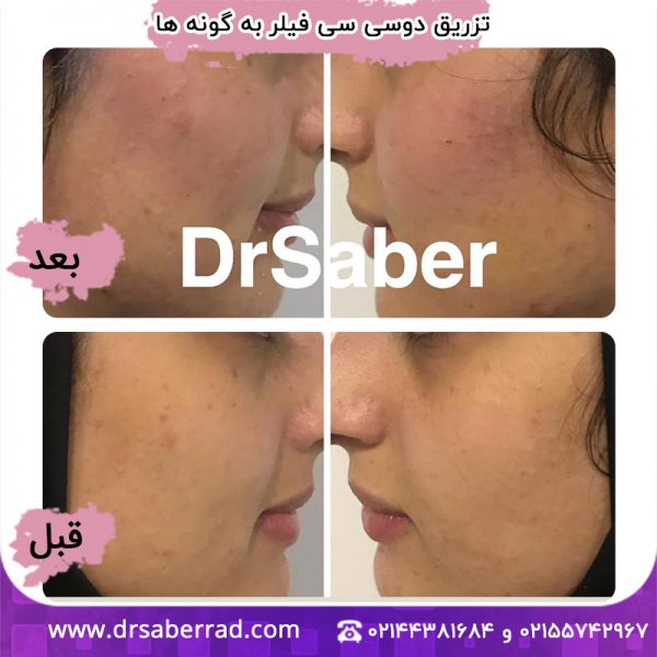 تزریق دو سی سی فیلر به گونه ها