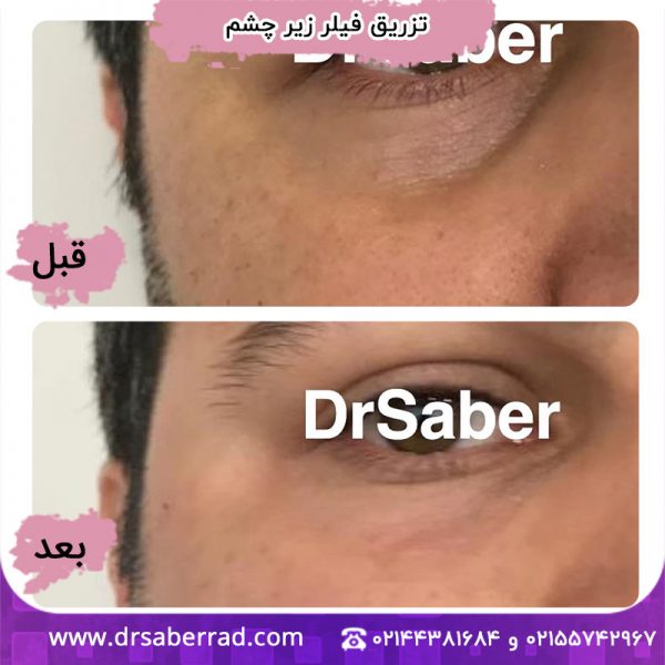 تزریق فیلر زیر چشم