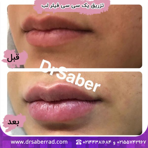 تزریق یک سی سی فیلر لب