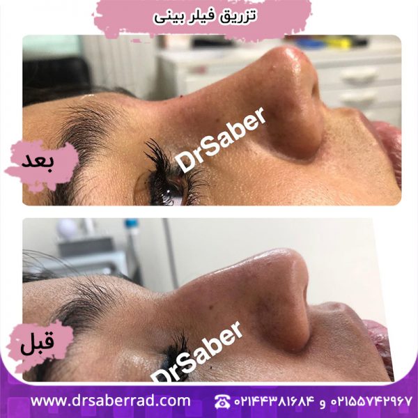 تزریق فیلر بینی